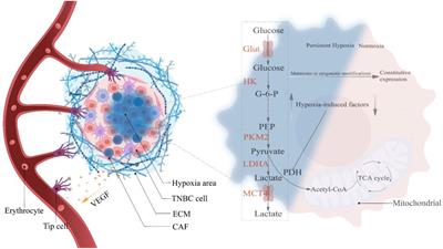 Correlation between the Warburg effect and progression of triple-negative breast cancer